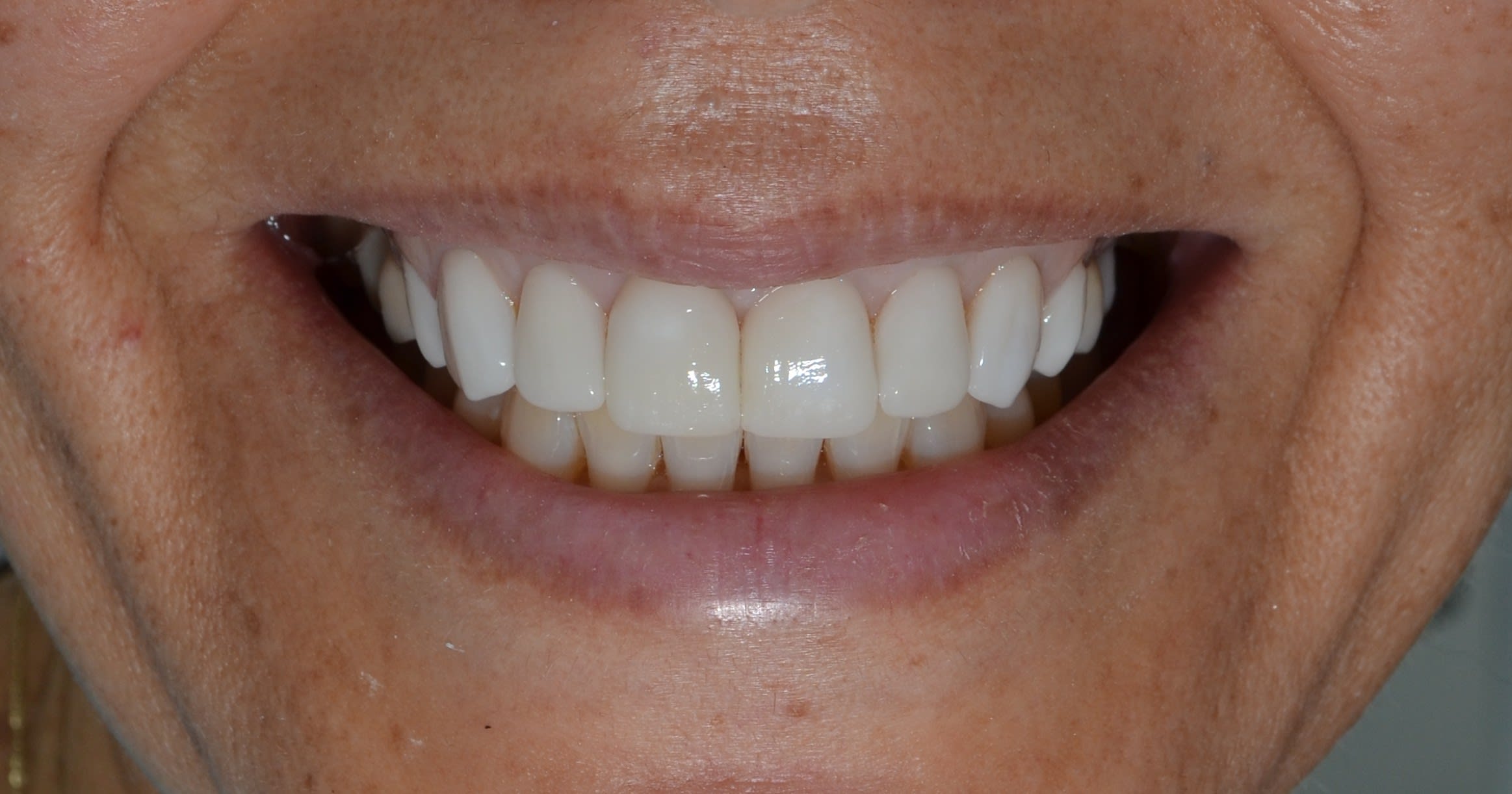After same day veneers treatment — case 3