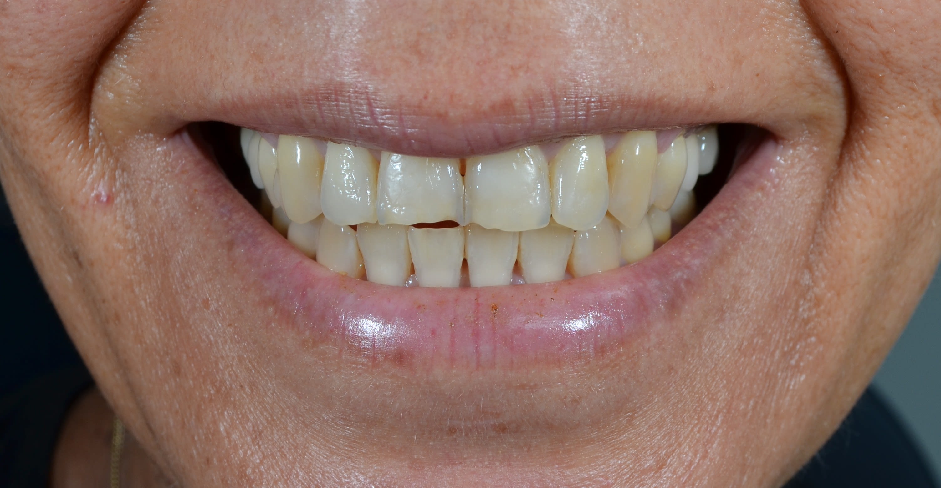 Before same day veneers treatment — case 3