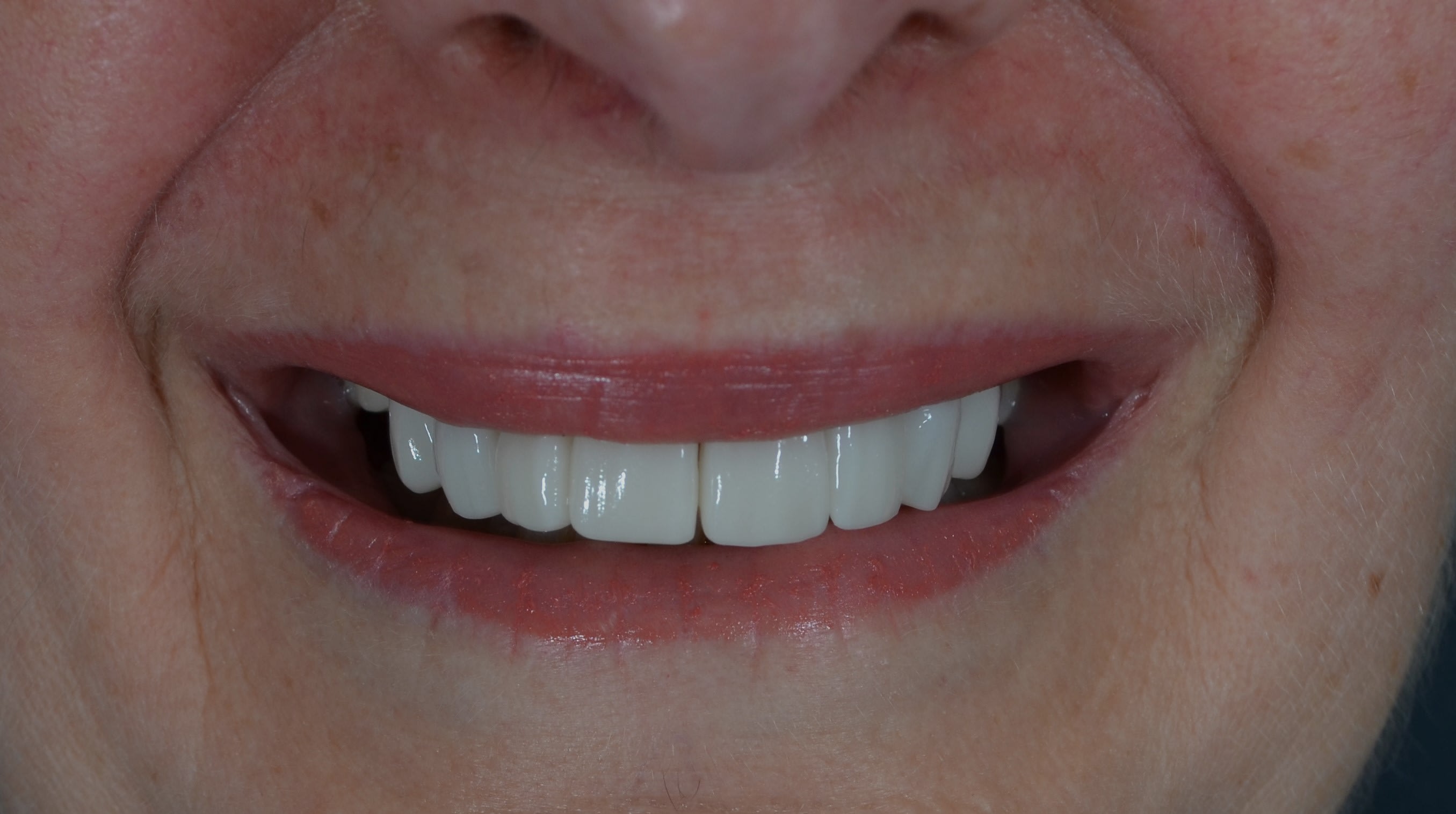 After same day veneers treatment — case 4