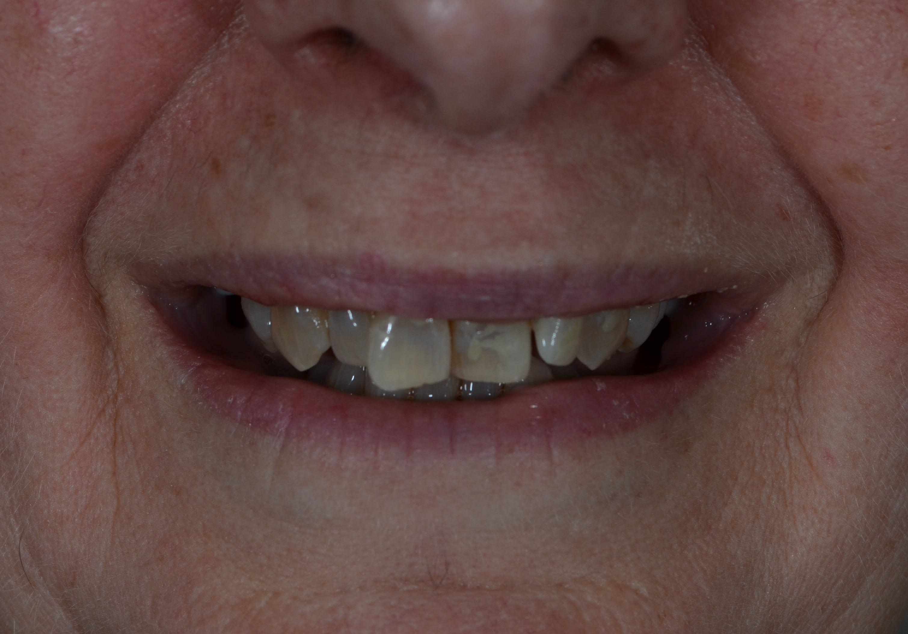 Before same day veneers treatment — case 4