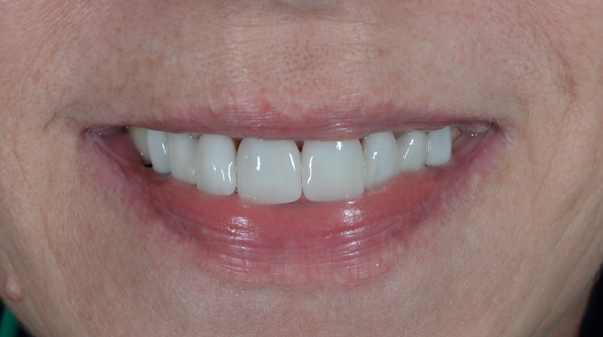 After same day veneers treatment — case 5
