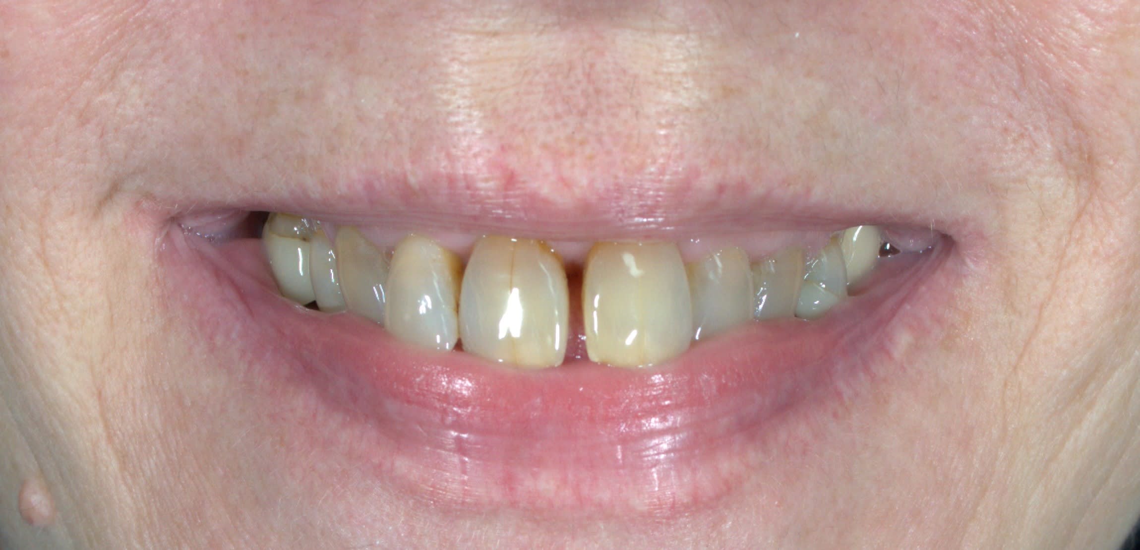 Before same day veneers treatment — case 5