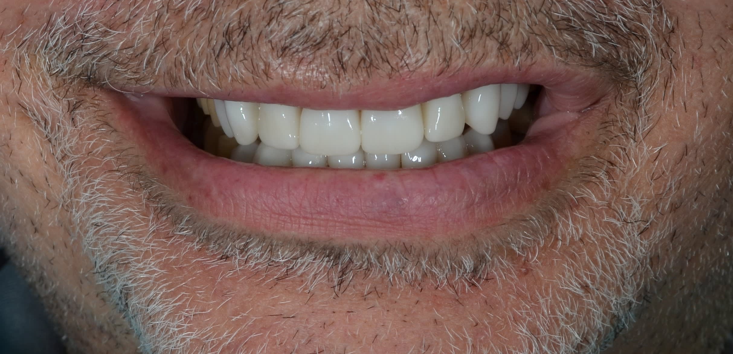 After same day veneers treatment — case 6