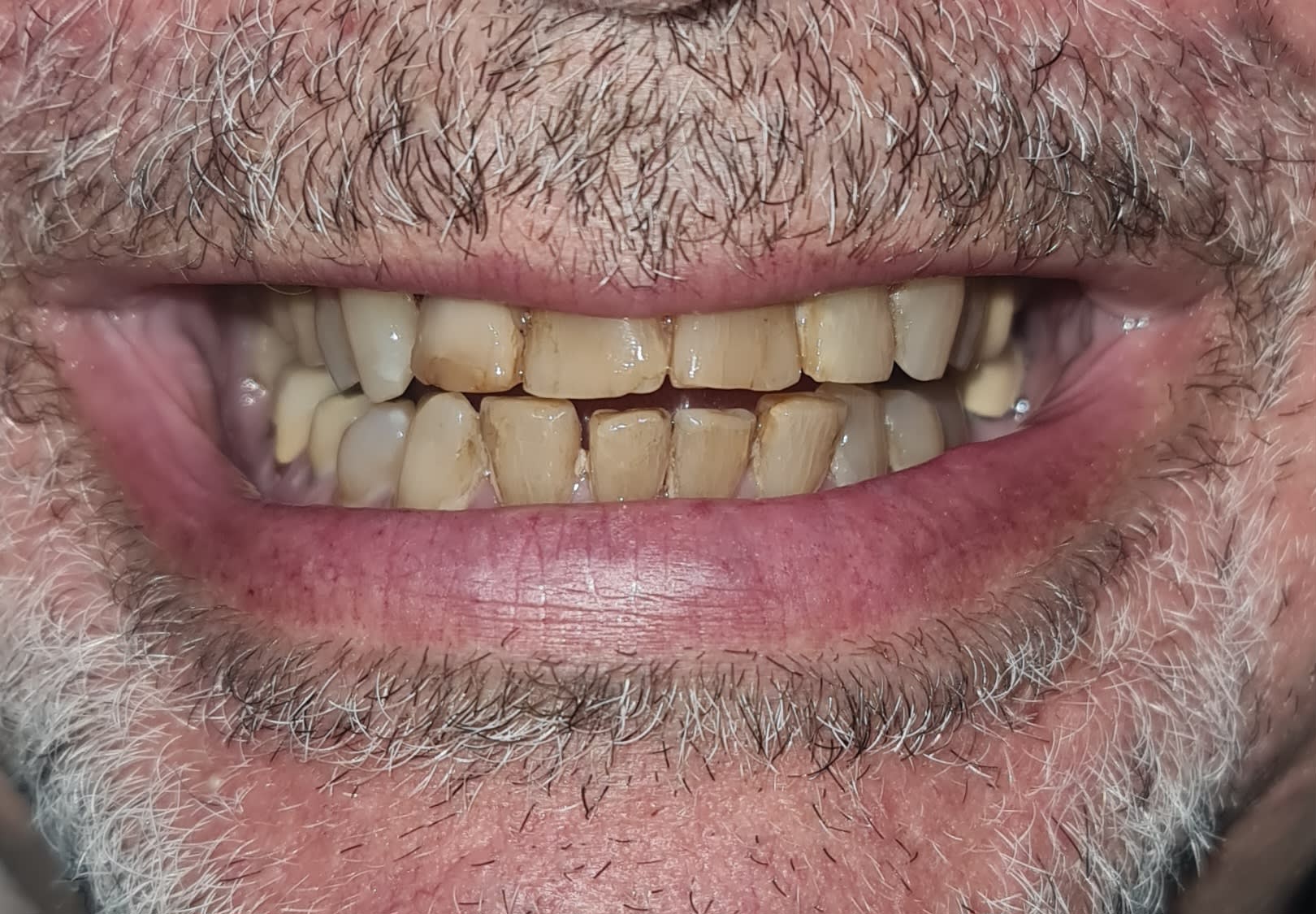 Before same day veneers treatment — case 6
