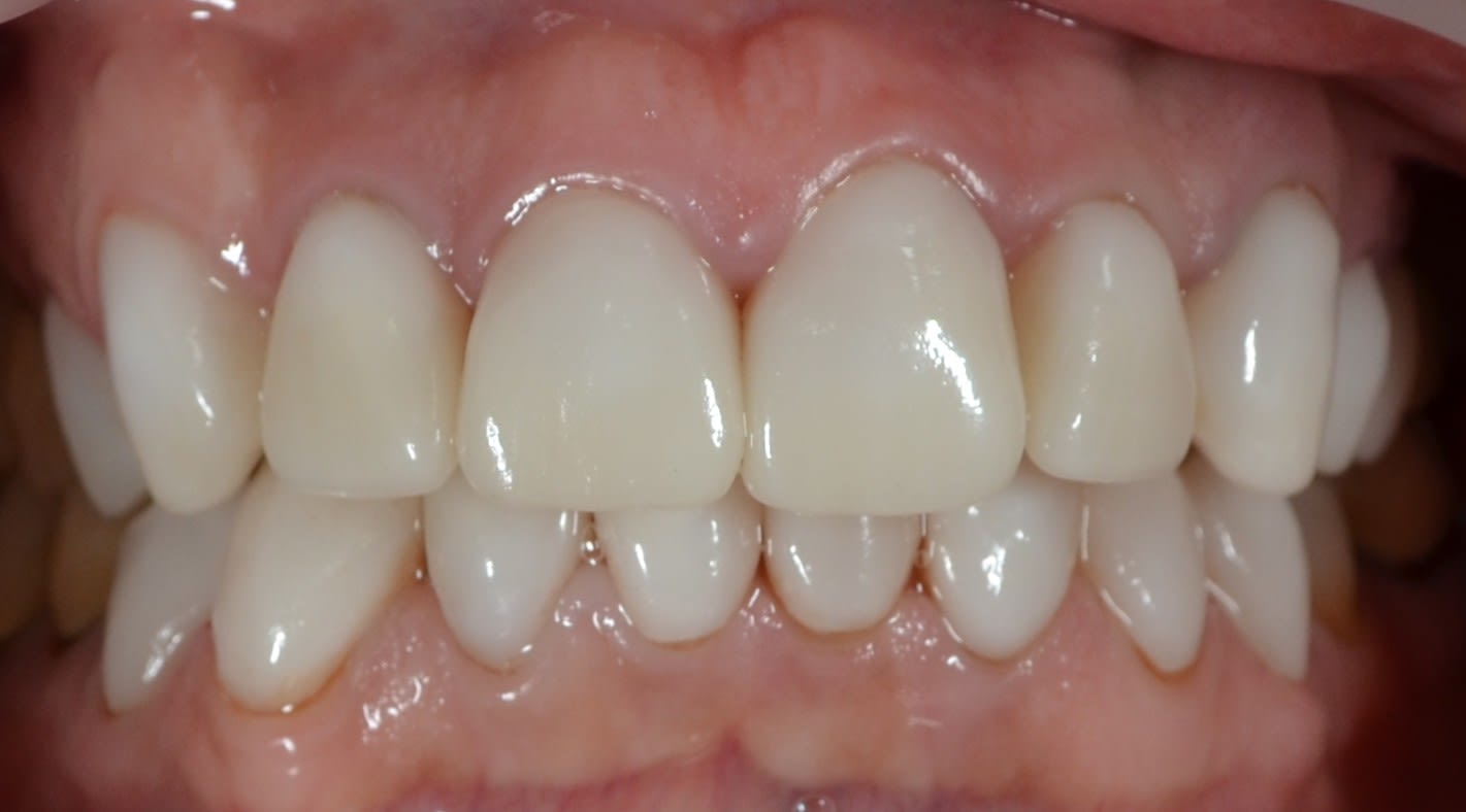 After same day veneers treatment — case 7