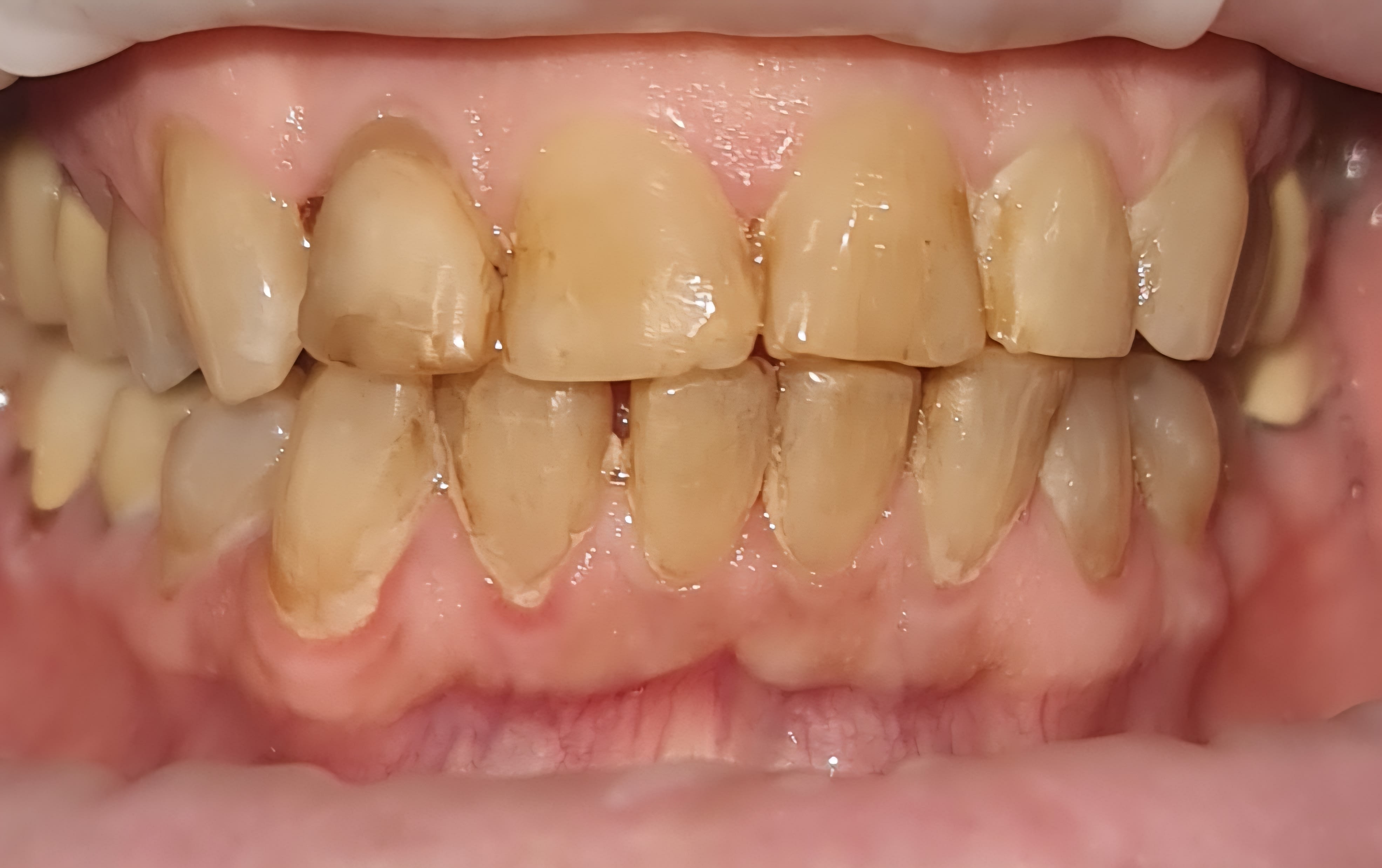 Before same day veneers treatment — case 7
