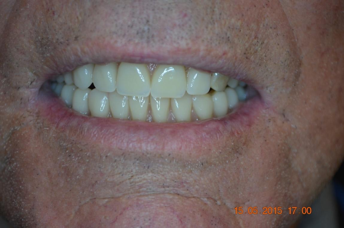After treatment: a restored smile with the implant-supported overdenture in place