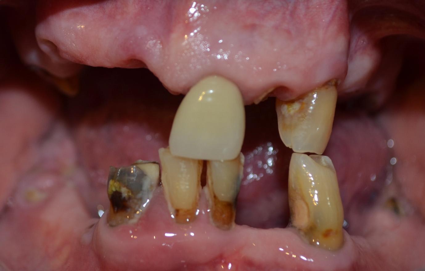 Before treatment: a failing lower dentition with broken and decayed teeth