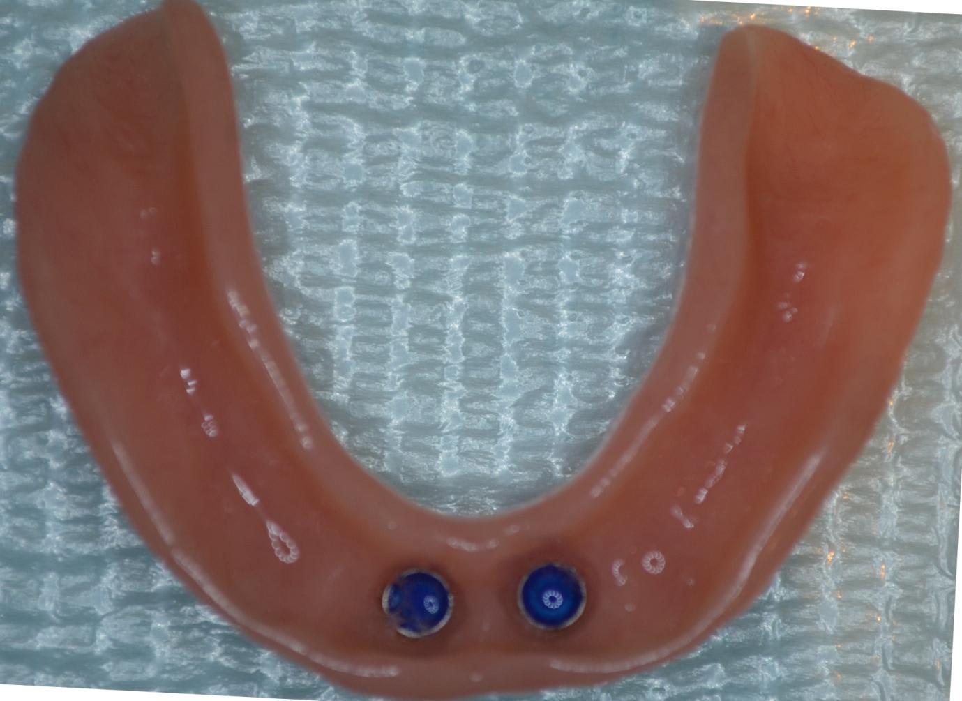 The underside of the denture showing the clip housings that lock onto the implants
