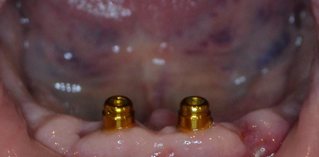 Two implant attachments in place on the lower jaw