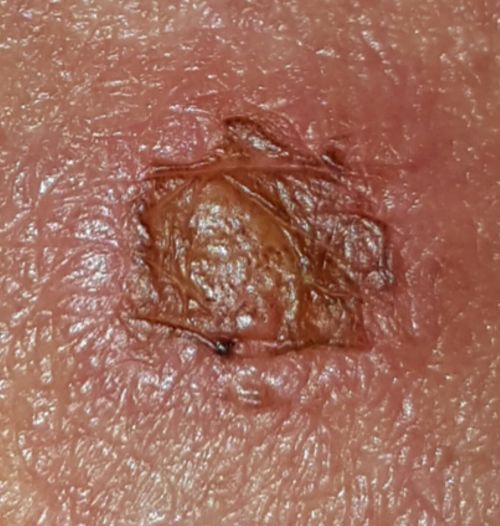 genital warts vs skin tags male