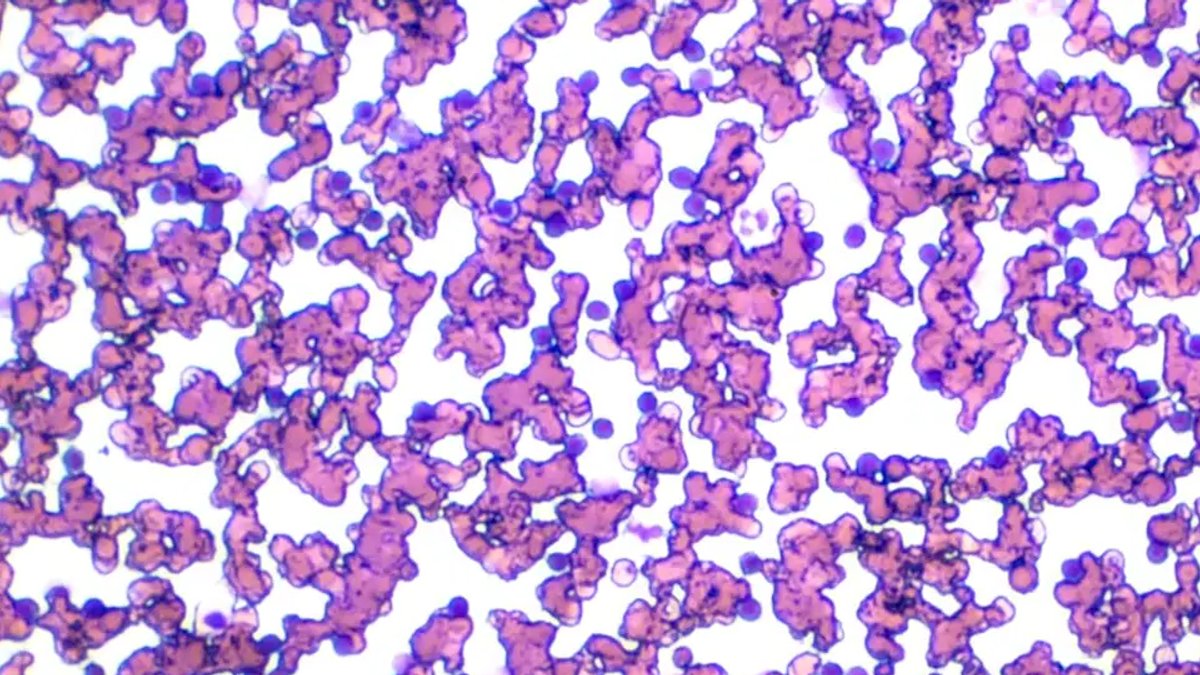 FDA Approves Jaypirca for Untreated CLL and SLL - jaypirca cll