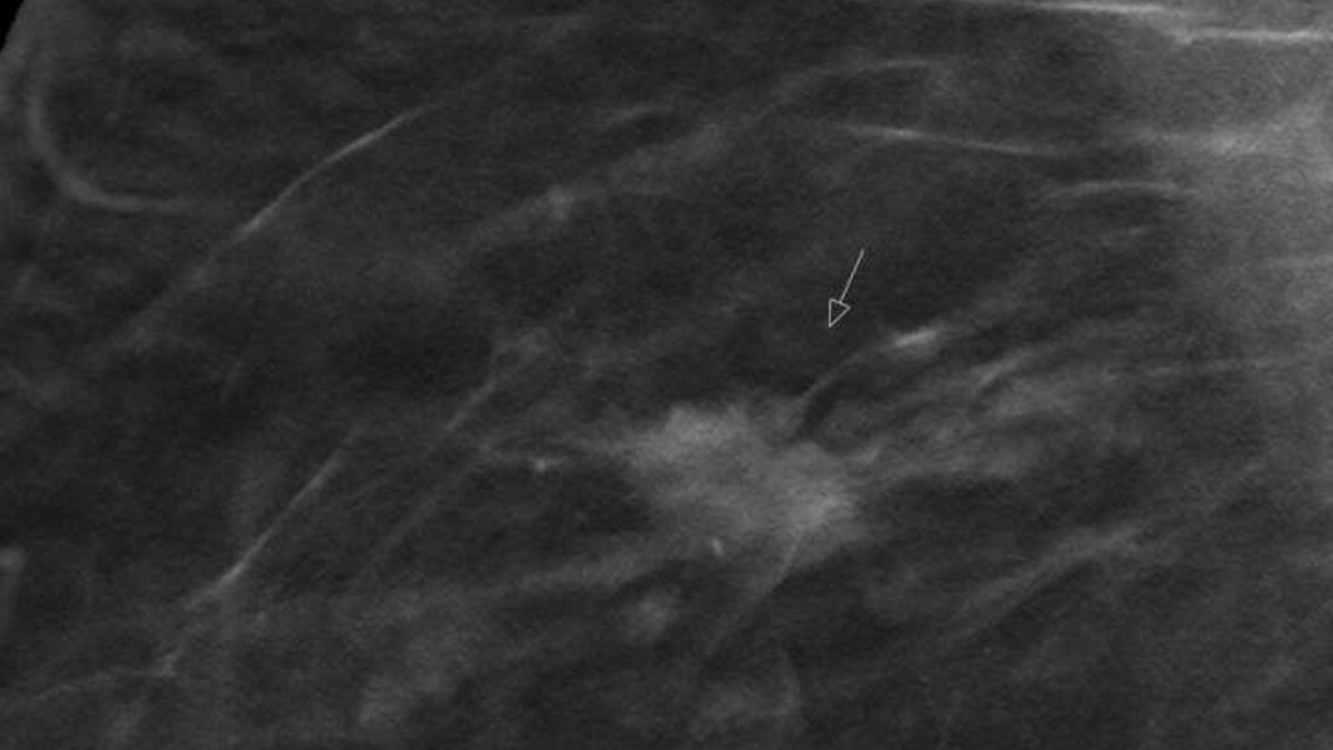 Digital breast tomosynthesis reveals early-stage breast cancer by highlighting surrounding structural abnormalities (arrow).