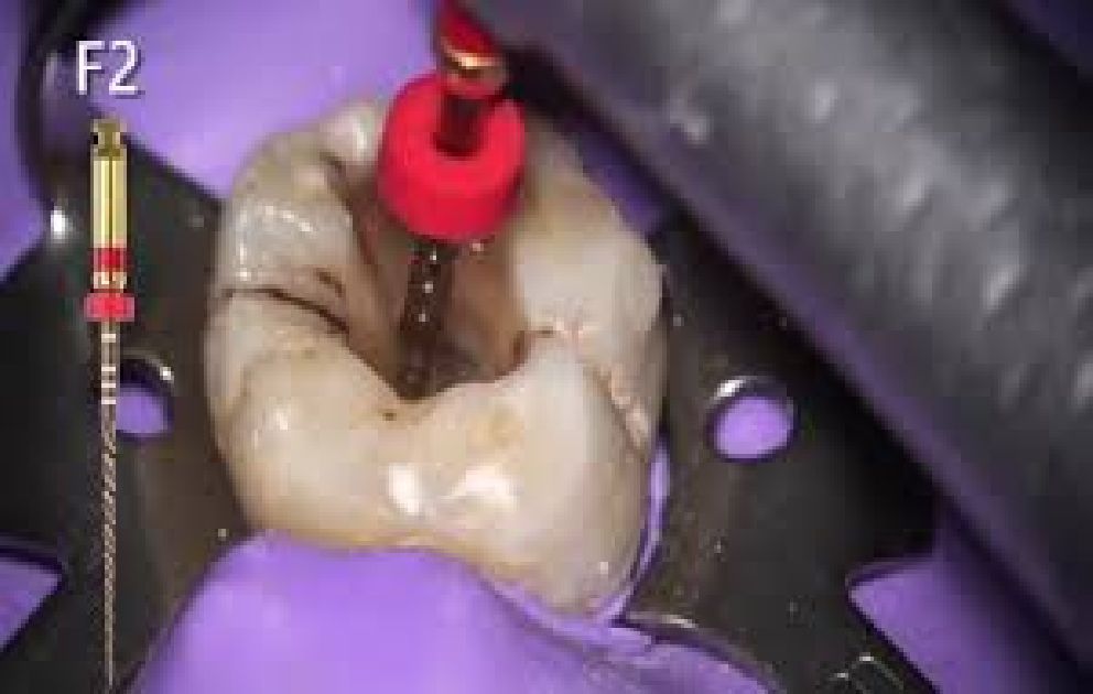 Step by Step Root Canal Treatment (RCT) using Protaper®