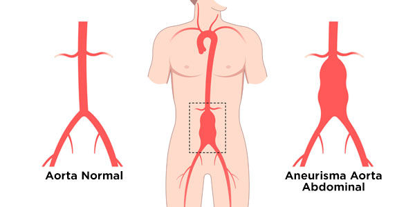 Aneurisma Aorta Abdominal