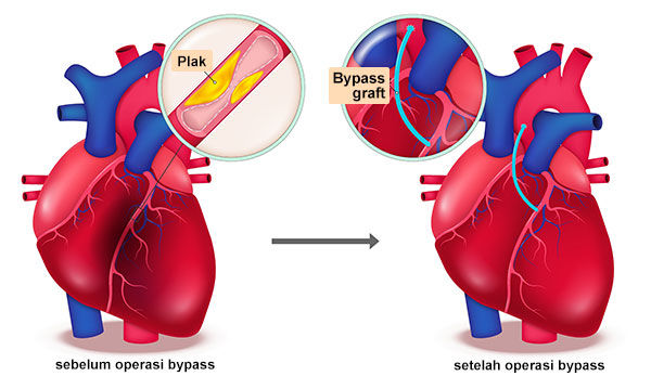 Gambar Bypass pada Arteri Jantung