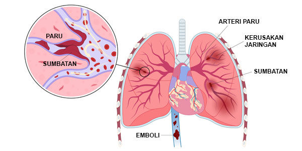 Gambar Emboli Paru