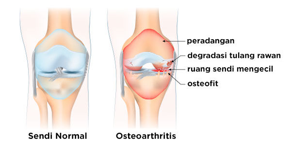 Gambar Kondisi Osteoarthritis