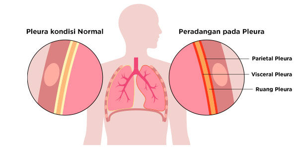 Gambar Kondisi Pleuritis