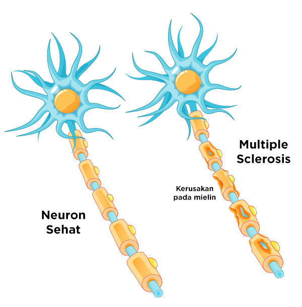 Ilustrasi Multiple Sclerosis
