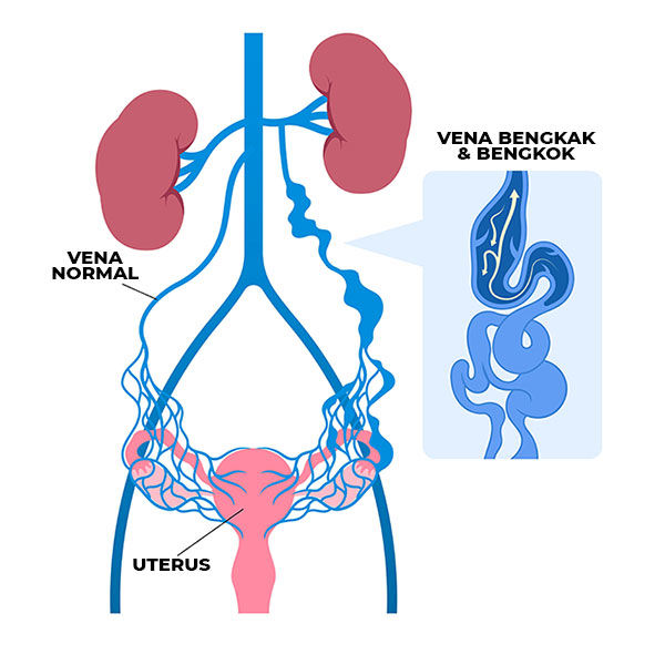Gambar Pelvic Congestion Syndrome