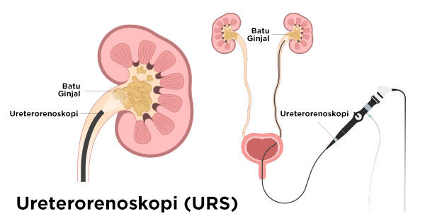 Gambar Ureterenoskopi (URS)