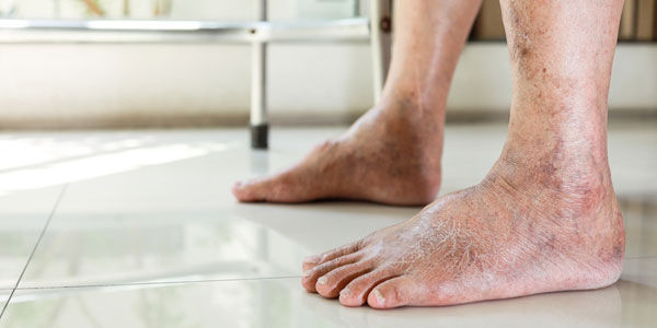 Kaki bengkak salah satu gejala gagal ginjal akut