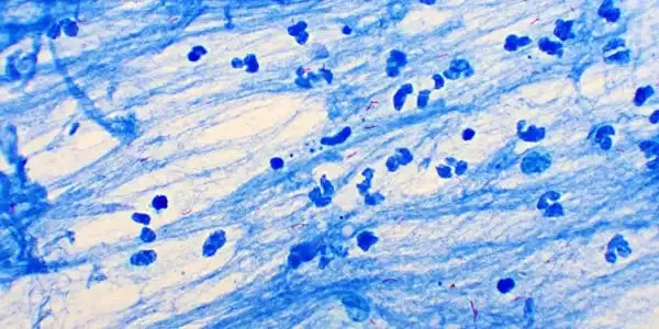 Gambar Mycobacterium tuberculosis