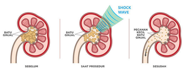 Prosedur ESWL