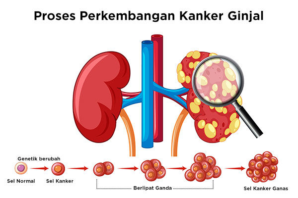 Proses Perkembangan Kanker Ginjal