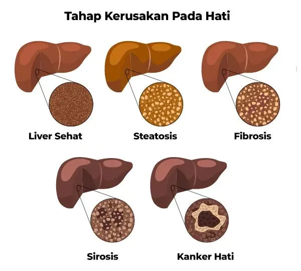 Tahap Kerusakan pada Hati