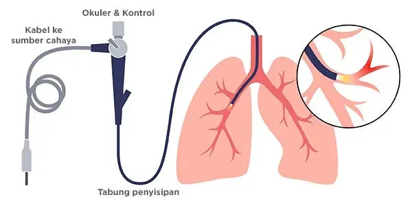 Alat Bronkoskopi