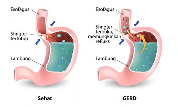 Visualisasi GERD