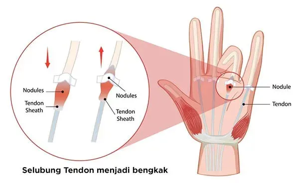 Visualisasi Trigger Finger
