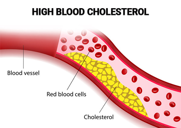 High blood cholesterol