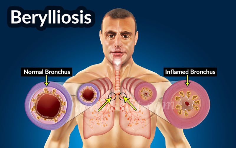 Berylliosis Бериллий чем опасен для человека