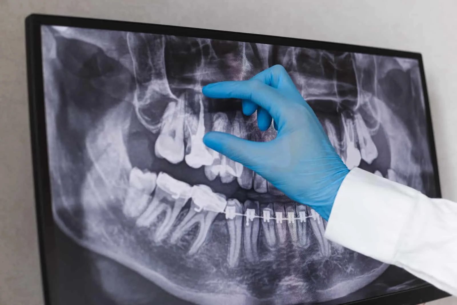 What Should I Do If I Have Dental Implants And Need Radiation Therapy?