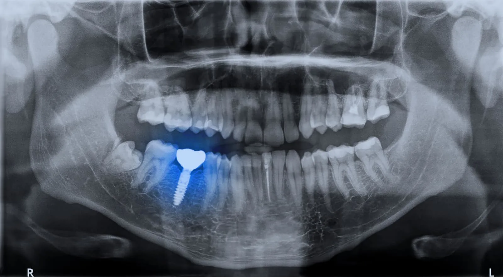Is It Safe For Someone With Dental Implants To Go For MRI Scans?
