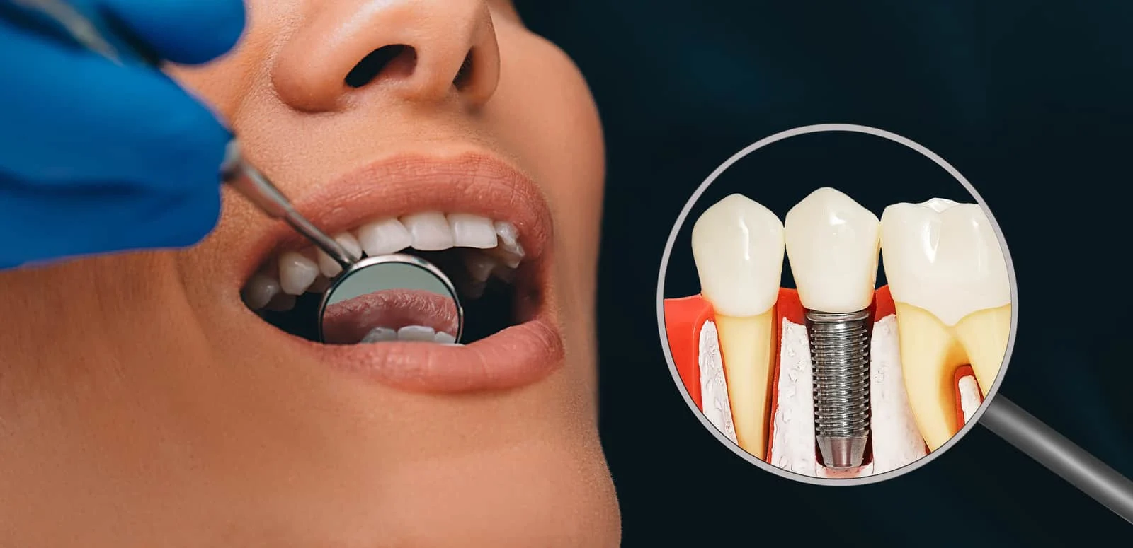 Common Risks Associated With Immediate Dental Implants