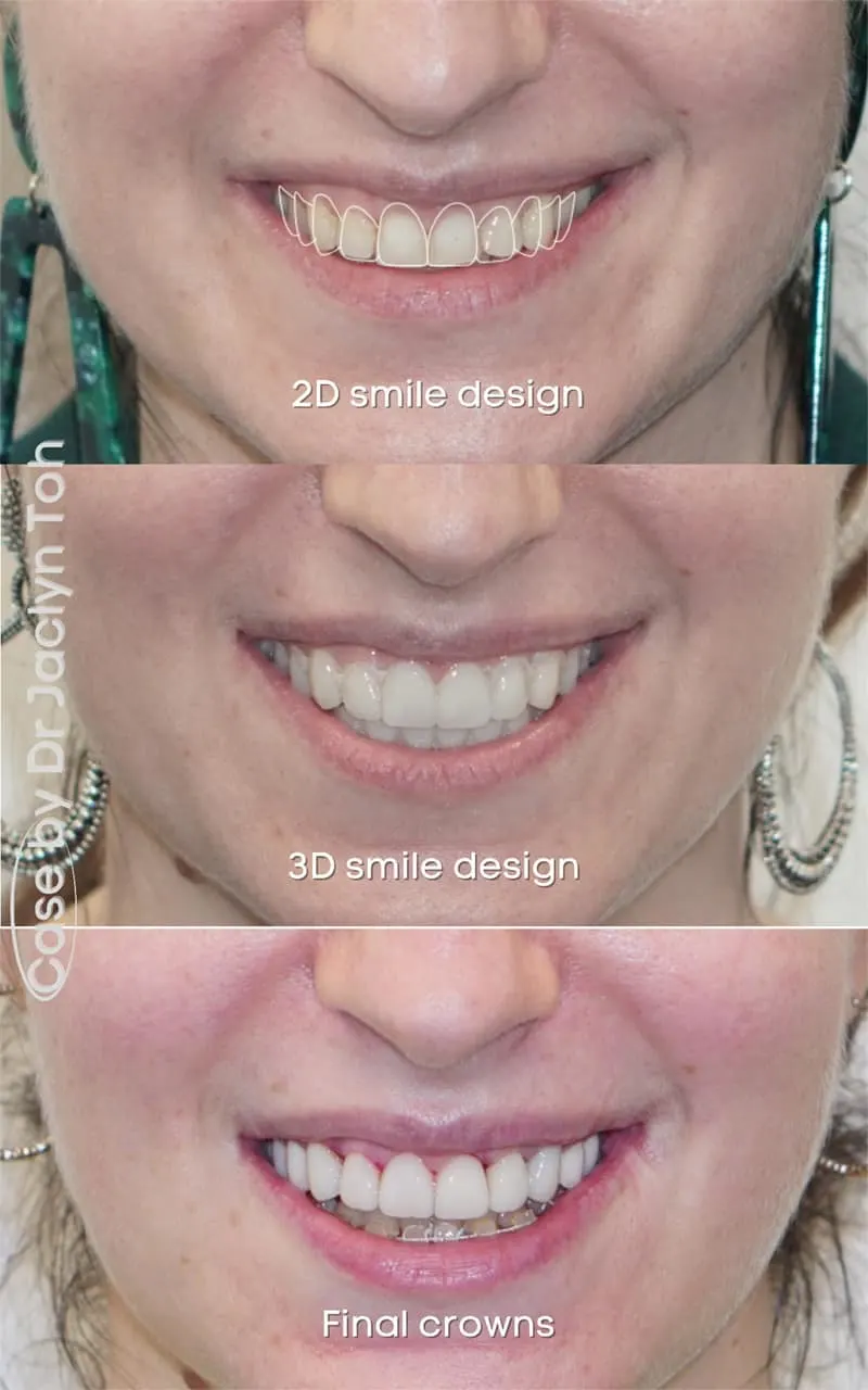 Digital Smile Design: Personalised Smile Makeover | Elite Dental Group digital-smile-design-personalised-smile-makeover-elite-dental-group