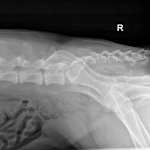 Case 4 R Lateral Lumbar Spine