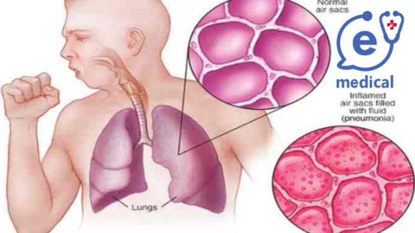 নিউমোনিয়া সামাল দেয়ার কিছু উপায়