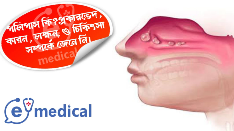 পলিপাস কি? প্রকারভেদ, কারণ, লক্ষণ, ও চিকিৎসা সম্পর্কে জেনে নি..