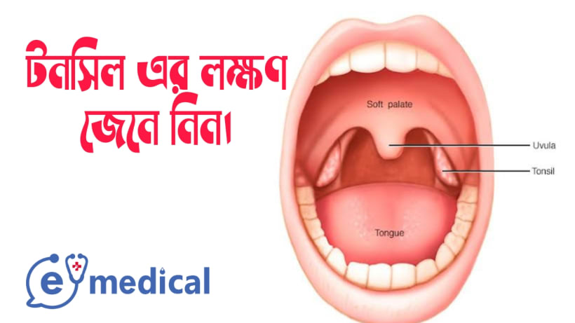 টনসিল এর লক্ষণ জেনে নিন