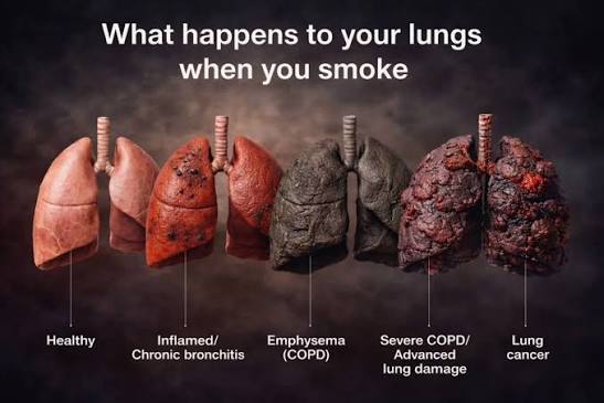 Smokers Lungs Tar Accumulation Image Placeholder