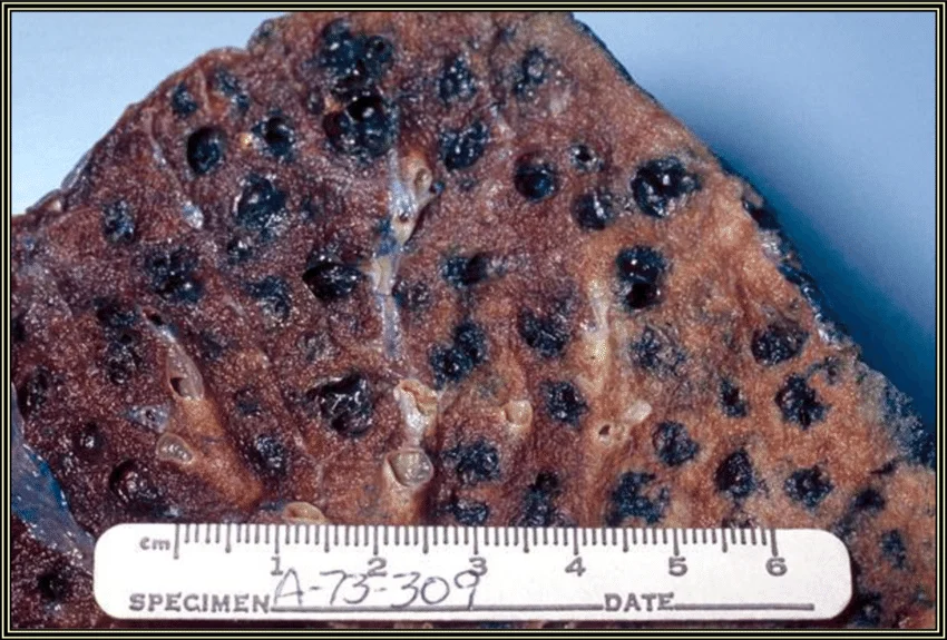 Emphysema & Airway Blockage Image Placeholder