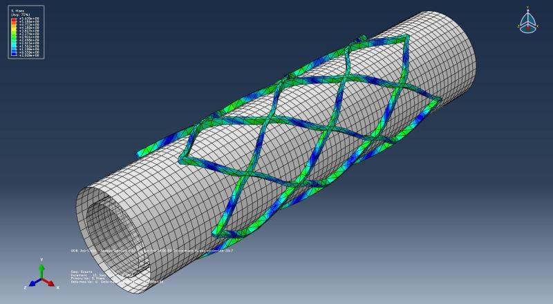 stent_open_1_rba47i.jpg