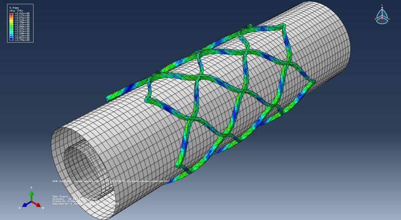 stent_open_2_btktfj.jpg