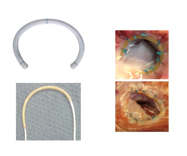 (Left) the growth-accommodating implant was designed for pediatric applications. (Right) Images of the device implanted in a piglet heart (upper image: right after implant, lower image: after 12 weeks.) (Image courtesy of Randal McKenzie.)