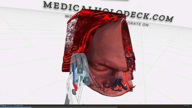 In the application seen in the snapshot above, users put on the Meta 2 headset, and work with computed tomography (CT) and MRI scans as immersive 3D models. Since the application performs volume rendering, a strong GPU is needed to the tethered workstation or laptop. The full-version of the application costs USD$149 on Steam. There is a personal version of Medical Holodeck available, which allows users to upload and navigate their own CT scan and MRI data. Medical Holodeck could be used by instructors for medical classes. Students can use a headset of their own, a tablet, desktop or laptop computer to follow along. Users communicate by audio and each can select their own point of view when replaying a lesson. Radiologists and surgeons can upload patient-specific CT or MRI data and use virtual cutting tools to discuss and walk through surgeries. Patients can be shown data of their own bodies, while attending doctors and other medical professionals discuss treatment with them.